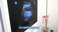 跟拍老婆做羊膜穿刺全过程，男人一定要看看！