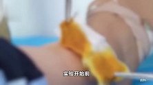 浙江女子一觉睡醒长出“蟒蛇纹”！这个习惯很多人都有，最近又开始了