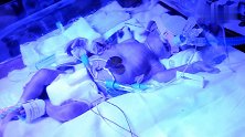 黄疸超标的早产儿正在照蓝光，身上贴满仪器，让人看得好心痛