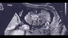 怀孕20周的B超影像，教你如何识别胎儿性别，赶紧收藏！