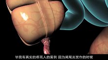 阑尾炎手术是如何进行的？动画演示过程，拔出来的瞬间看的好过瘾