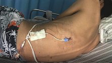 福州一患者用药后感染肺结核 医院被认定造成四级医疗事故