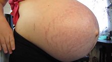 孕妈怀孕40周，肚子大到长满妊娠纹，怀孕妈妈真是太辛苦了
