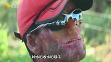 晒太阳就生病！巴西村民在阳光下工作患病致对紫外线过敏，耳聋肌肉能力差！