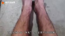 世界上“体毛”最长的女人，脱毛成功之后，大量的男生排队追求
