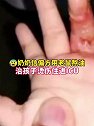 河南郑州：奶奶用老鼠熬油治孩子烫伤致感染