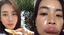 女子吃蜂巢被蛰成香肠嘴 当事人：喝水都漏
