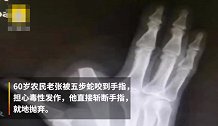 男子被五步蛇咬伤，忍痛断指，医生直言没必要，盲目自救不可取！