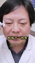 钟医生亲身示范打肉毒毒素！#皮肤管理 #肉毒毒素
