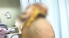 广西南宁：偏信游医“土方法” 女子头顶长出菠萝大肿瘤