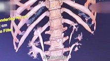女子天生4个肾竟全部长结石，医生紧急提醒！