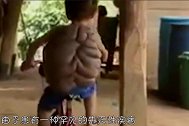 印度男童得“怪病”，背部长出乌龟壳，专家：“龟仙人”？