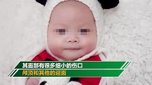2月大女婴独自在家遭动物啃咬血肉模糊：将落下终身残疾