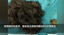 14岁少女异食癖多年薅头发吃进胃里，手术后取出5斤毛球
