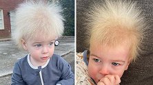 美国小男孩患有罕见“乱发综合征” 头发四面八方生长像蒲公英
