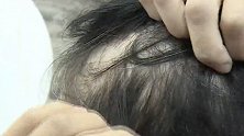 湖南长沙：女子烫发后遇“秃头”危机：“我以为得了绝症”