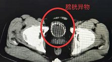 男子排尿疼痛被紧急送医 医生发现他膀胱内一条40厘米长橡胶管