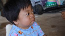 心疼！云南5岁女童患罕见病 面容比妈妈苍老