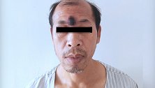 51岁大叔挤额头“痘痘” 竟挤出恶性肿瘤