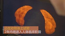 澳大利亚研发出预防阿兹海默症的疫苗 成功后5到10年可问世