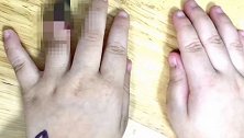 湖北武汉：被截指！3岁女童手指受伤，家长一个举动酿大祸
