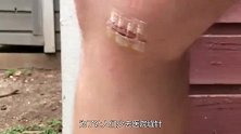 美国发明无痛缝合贴，不用给伤口缝针，轻轻一拉就能缓慢愈合！