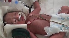 提前两个月降生！新生儿被固定在床上，脑袋不能动，好心疼