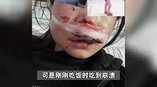女孩称跨年夜有人朝人群扔炮仗，自己脸被炸缝20针，全网重金征线索找肇事者