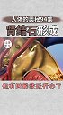 健康养生喝水少、排尿少、出汗多，夏季更肾结石高发季 打败结石
