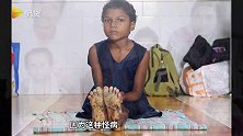 精神摧残！印度三姐妹患皮肤病脚底生长厚肿块无法正常行走，看着都疼！