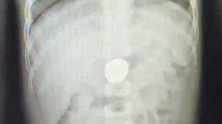 广东深圳：危险！6岁男童好奇吞硬币，卡在胃里一星期出不来