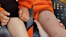 福建7名幼儿身上现针孔孩子称被保育员用针扎：警方介入调查