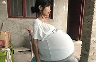 什么病？贵州一女子2年内肚子长成一个巨球 病因至今未明