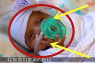 女孩一出生就自带蝙蝠胎记，父母选择保留，网友：好残忍！