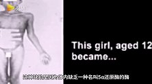 男女共生？一村落患罕见遗传病，居民出生时为女孩到青春期便成为男孩！