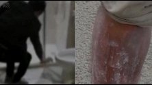 男子住酒店半夜脚趾突然一阵剧痛 整条腿肿得通红十分吓人
