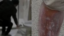 男子住酒店半夜脚趾突然一阵剧痛 整条腿肿得通红十分吓人