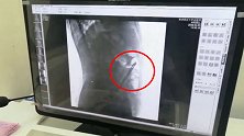 68岁患者腹腔内现金属筷子 医生：从肛门进入，实属罕见