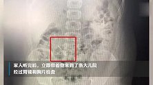 10岁男孩连吞4枚定位针，吃了一种蔬菜后，竟自行排出