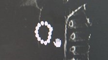 揪心！浙江16个月宝宝吞食14颗磁力珠 致肠胃6处穿孔