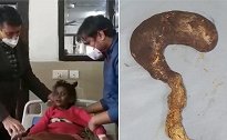 印度一6岁女童因腹痛就医 医生从其胃里取出3斤毛发
