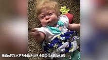 女婴患怪病 全球仅72例 医生断言只能活到3岁！