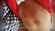 儿童医院92名儿童现不良反应 暂停三伏贴