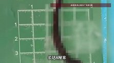 8厘米活蚂蟥藏在气管里！云南男童咳血十余天，医生紧急取出