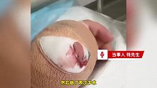 男子被超市老板咬伤，手术2次缝几十针险截肢：赔了几十万，人咬伤比宠物更可怕