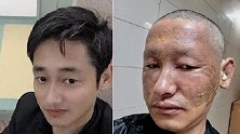 这两张自拍照让人心疼！辅警冲进火场救火被煤气罐炸伤近乎毁容