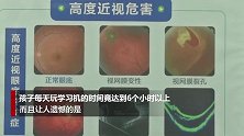 5岁男娃近视1000度不可逆转 医生查出“元凶”家长崩溃