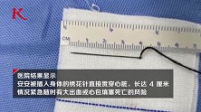 3月大婴儿心脏被绣花针刺穿 父亲：可能是妻子抑郁症发作导致
