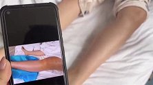 陕西西安：腿肿一大圈！14岁女孩竟得血栓？医生：很多诱因