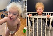 美国男婴患罕见“难梳头发综合征” 拥有爱因斯坦同款发型